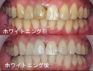 岡山県の歯医者さん・ホワイトニング